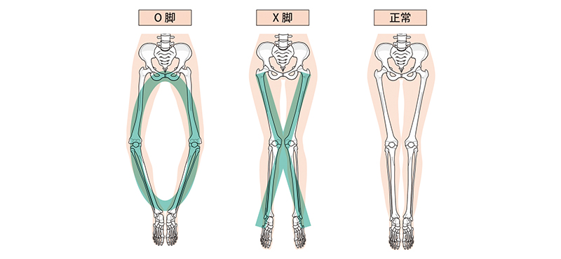 O脚、X脚、XO脚