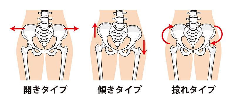 骨盤の歪み